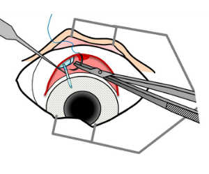 眼圧下げる手術