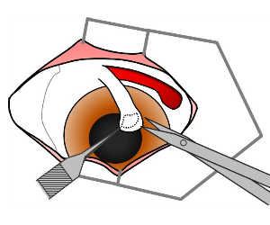 角膜潰瘍　治療