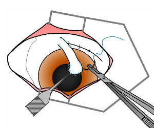 角膜手術